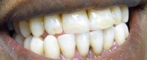 Die Frakturen der Zähne wurden mit Füllstoff aufgefüllt