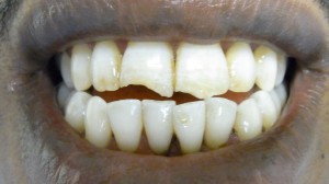 Frakturierte Zähne vor der Behandlung